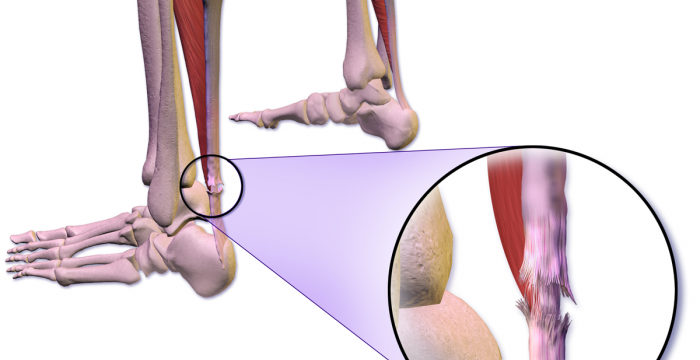 Torn achilles discount tendon nhs
